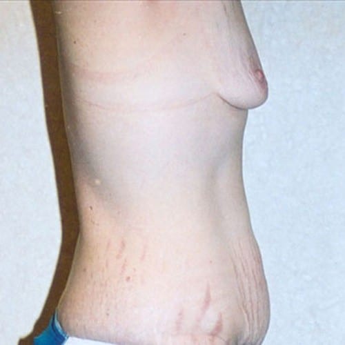 Breast Augmentation 13 Before Photo