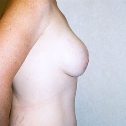 Breast Augmentation 13 After Photo