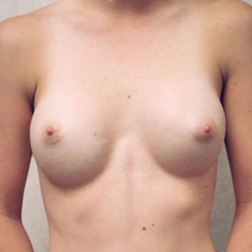 Breast Augmentation 14 Before Photo