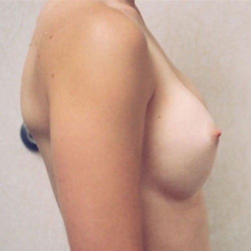 Breast Augmentation 14 Before Photo