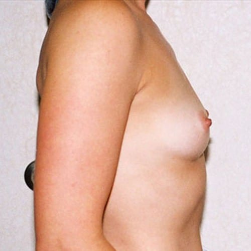 Breast Augmentation 16 Before Photo