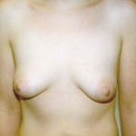 Breast Augmentation 18 Before Thumbnail Photo