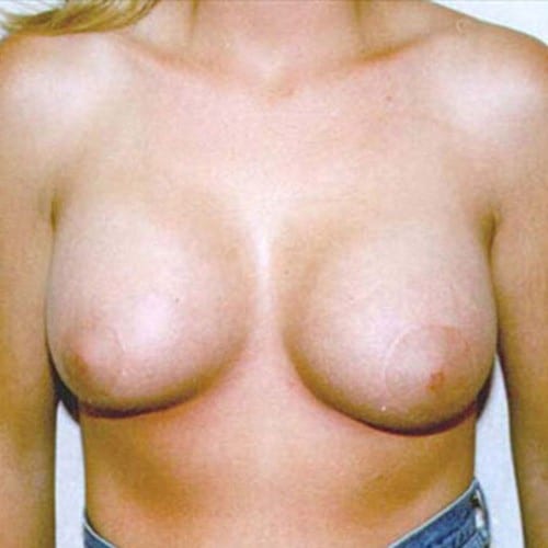 Breast Augmentation 18 After Photo