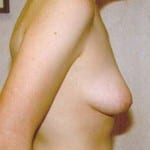 Breast Augmentation 18 Before Thumbnail Photo