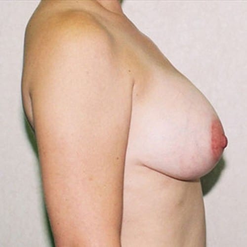 Breast Augmentation 19 After Photo