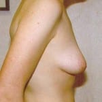 Breast Lift 02 Before Thumbnail Photo