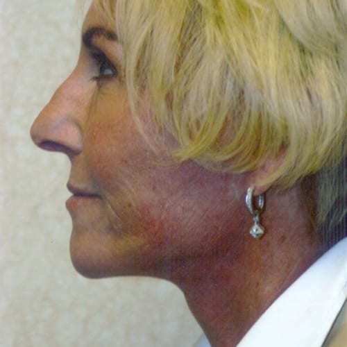 Facelift 04 After Photo