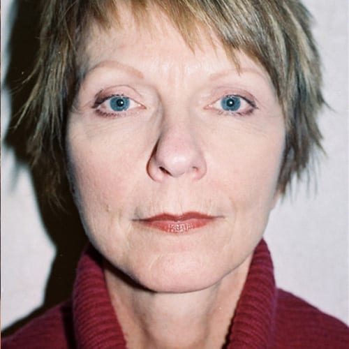 Facelift 08 After Photo