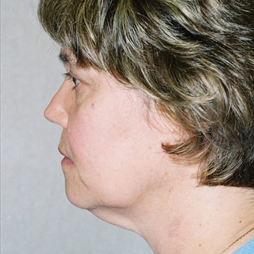 Facelift 10 Before Photo
