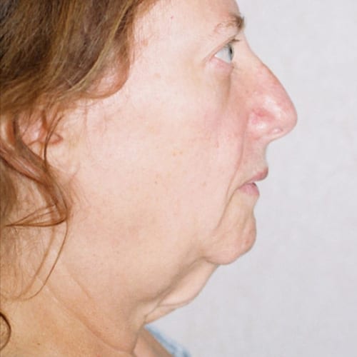 Facelift 13 Before Photo