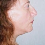 Facelift 13 After Thumbnail Photo