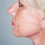 Facelift 15 After Thumbnail Photo