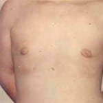 Gynecomastia 01 After Thumbnail Photo