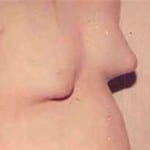 Gynecomastia 01 Before Thumbnail Photo