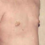 Gynecomastia 01 After Thumbnail Photo