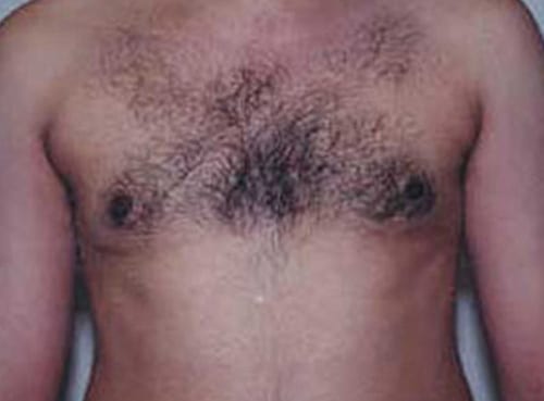 Gynecomastia 02 After Photo