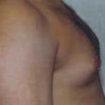 Gynecomastia 02 Before Thumbnail Photo