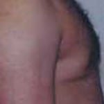 Gynecomastia 02 After Thumbnail Photo