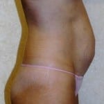 Mommy Makeover 02 Before Thumbnail Photo