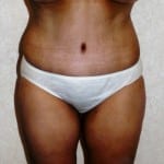 Abdominoplasty 02 After Thumbnail Photo