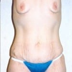 Abdominoplasty 03 Before Thumbnail Photo