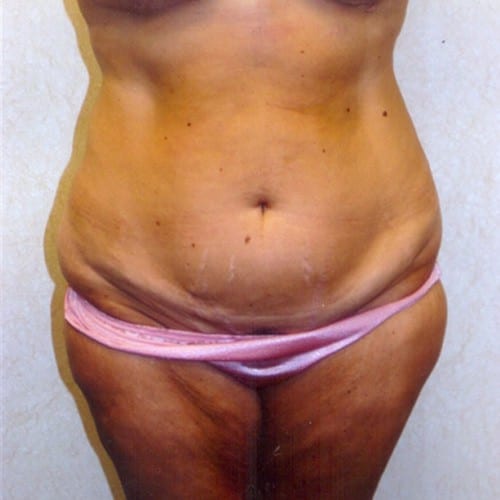 Abdominoplasty 04 Before Photo