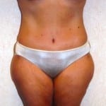 Abdominoplasty 04 After Thumbnail Photo