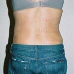 Abdominoplasty 05 After Thumbnail Photo