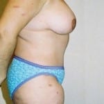 Abdominoplasty 06 After Thumbnail Photo