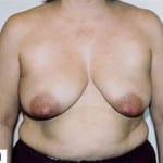 Breast Reconstruction 01 Before Thumbnail Photo