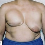 Breast Reconstruction 01 After Thumbnail Photo