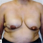 Breast Reconstruction 01 Before Thumbnail Photo