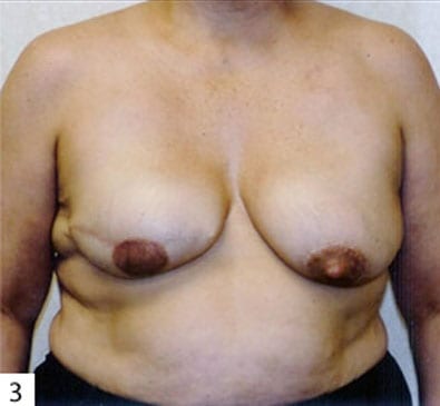 Breast Reconstruction 01 Before Photo