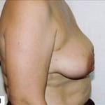 Breast Reconstruction 01 Before Thumbnail Photo