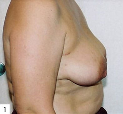 Breast Reconstruction 01 Before Photo