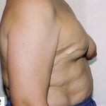 Breast Reconstruction 01 After Thumbnail Photo