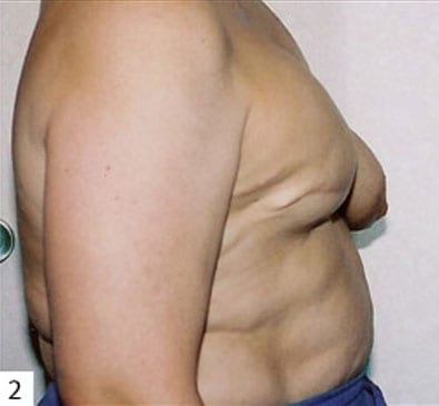 Breast Reconstruction 01 After Photo