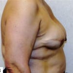 Breast Reconstruction 01 After Thumbnail Photo