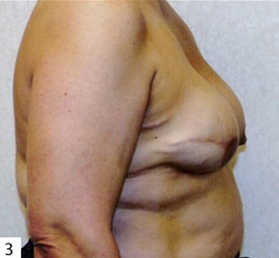 Breast Reconstruction 01 After Photo