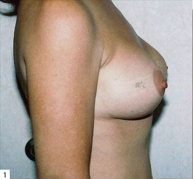 Breast Reconstruction 02 Before Photo