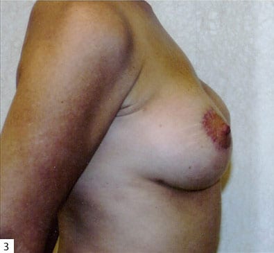 Breast Reconstruction 02 Before Photo