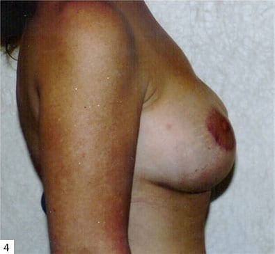 Breast Reconstruction 02 After Photo