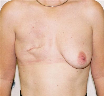Breast Reconstruction 03 Before Photo