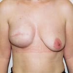 Breast Reconstruction 03 After Thumbnail Photo