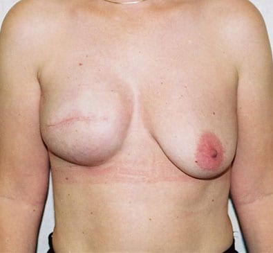Breast Reconstruction 03 After Photo