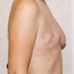 Breast Reconstruction 03 Before Thumbnail Photo