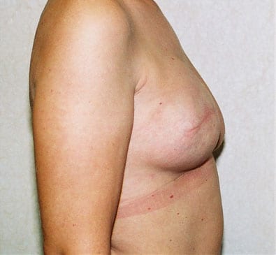 Breast Reconstruction 03 After Photo