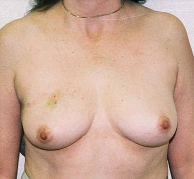 Breast Reconstruction 04 Before Photo