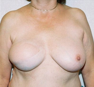 Breast Reconstruction 04 After Photo