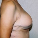 Breast Reconstruction 04 After Thumbnail Photo